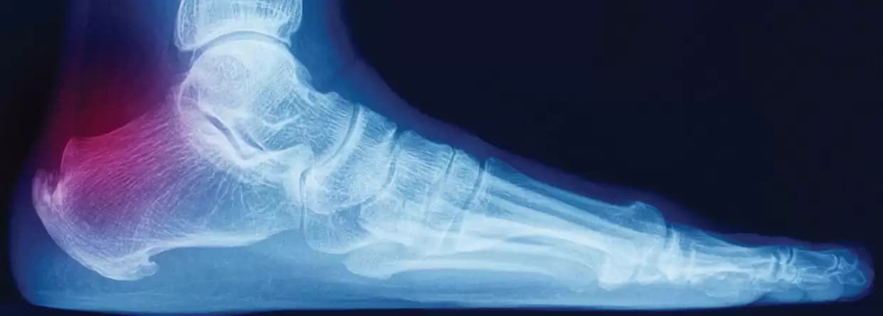 The Ultimate Guide to Plantar Fasciitis