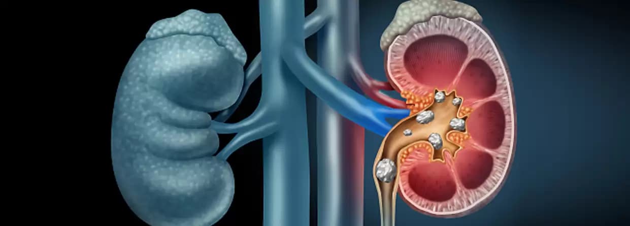 Prevention And Treatment Of Kidney Stones