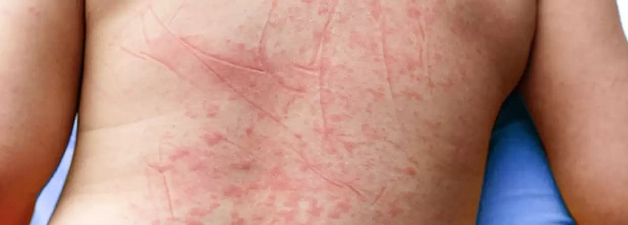 Everything You Need to Know About Dengue Hemorrhagic Fever