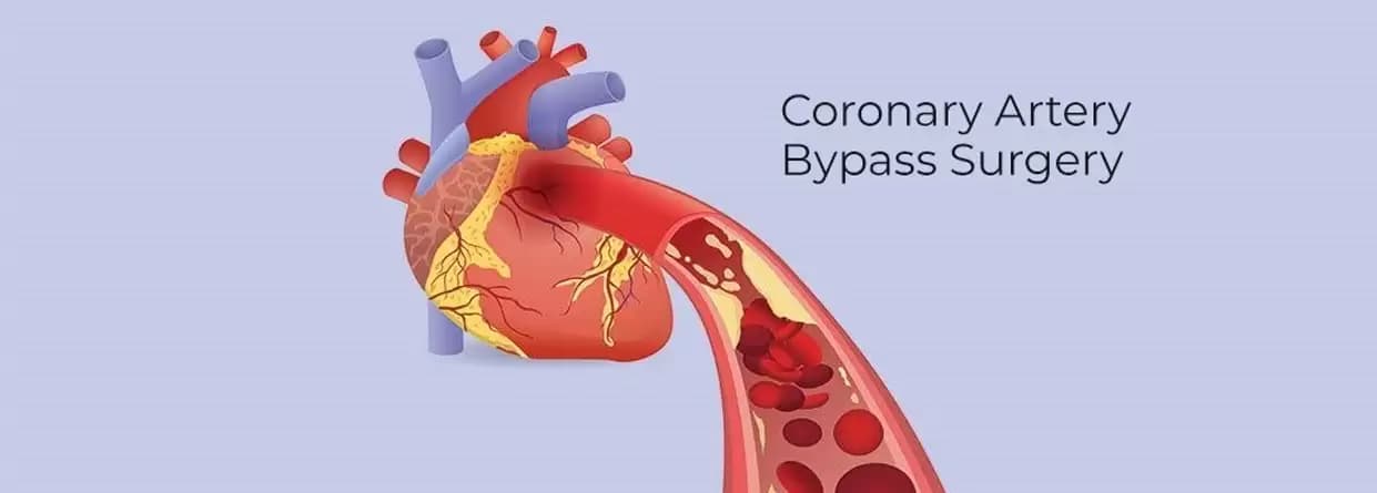 Coronary Artery Bypass Graft Surgery