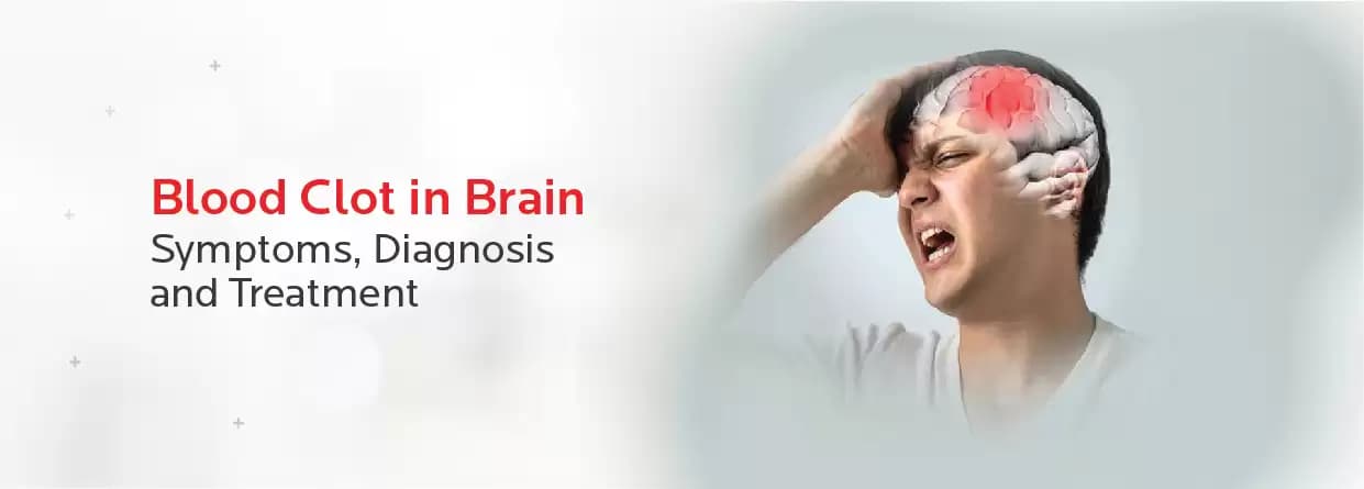 Blood Clot in Brain: Understanding Symptoms, Diagnosis & Treatment