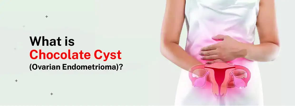 Chocolate Cysts: Symptoms, Causes, Risk Factors, Diagnosis, and Treatment Options