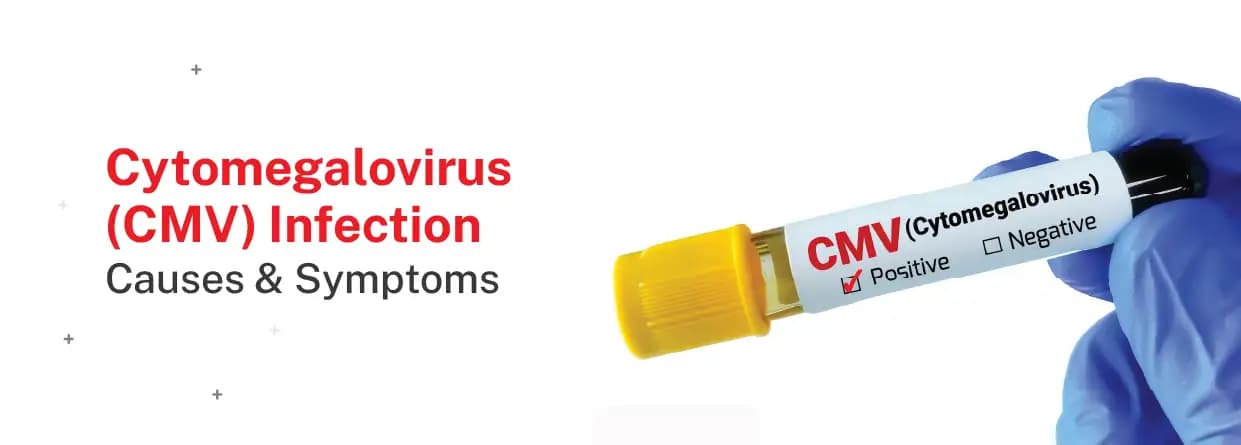 Cytomegalovirus (CMV) infection - Symptoms, causes & Treatment