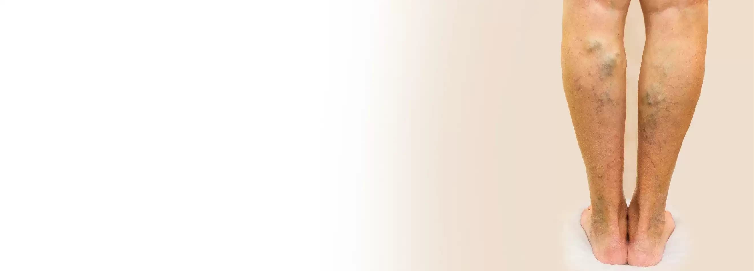 Varicose Vein Treatment