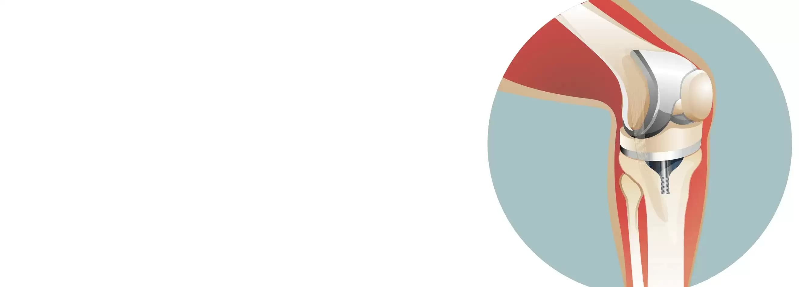 Knee Replacement Surgery