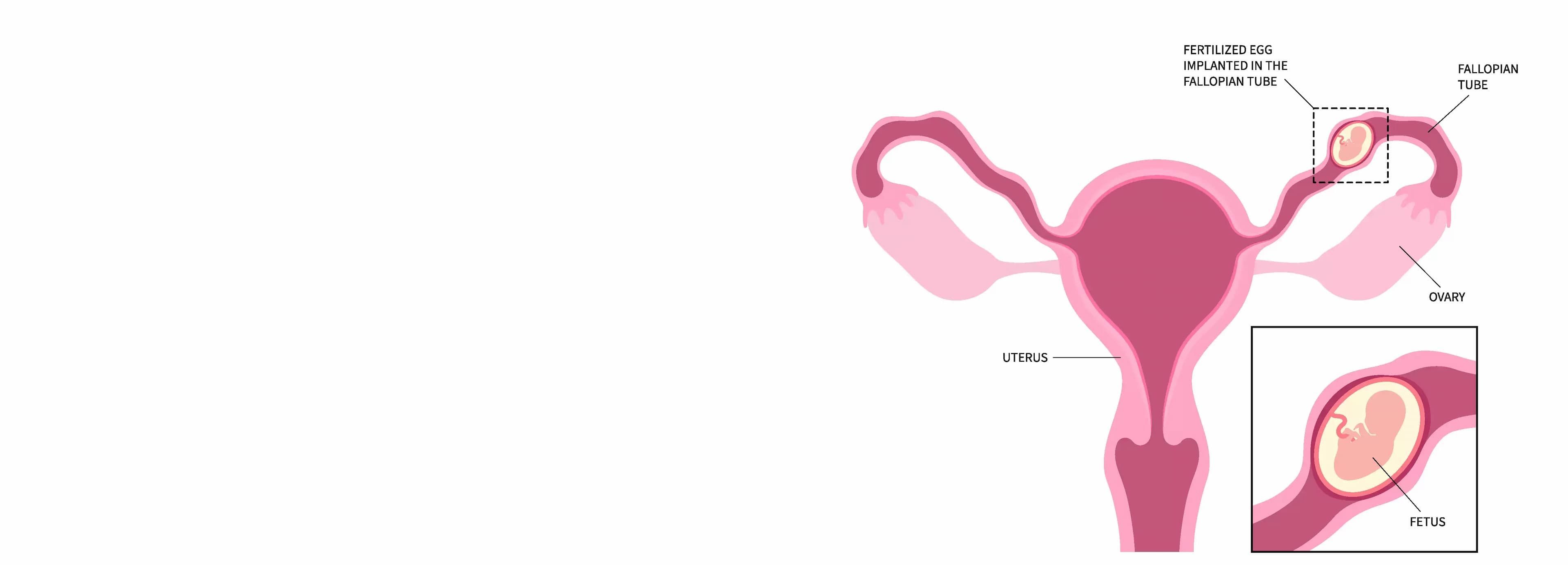 Ectopic Pregnancy Treatment