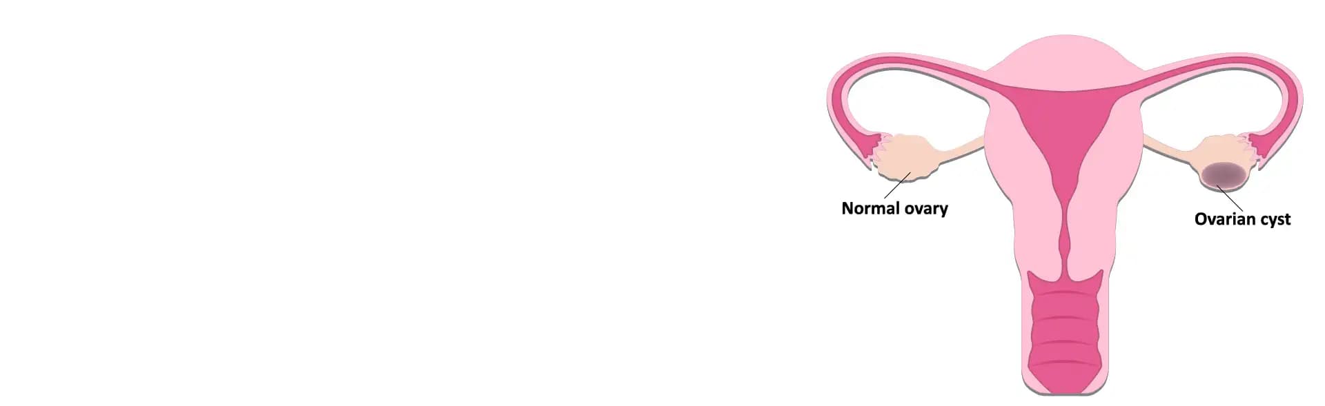 Ovarian Cysts Treatment