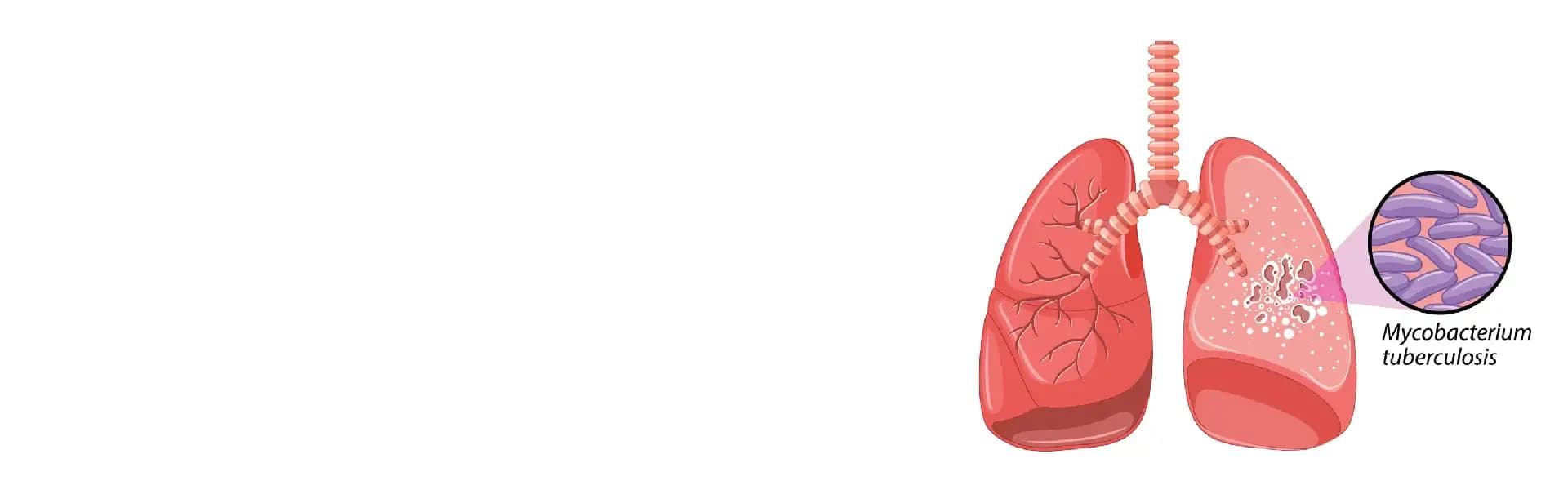 Tuberculosis (TB) Treatment