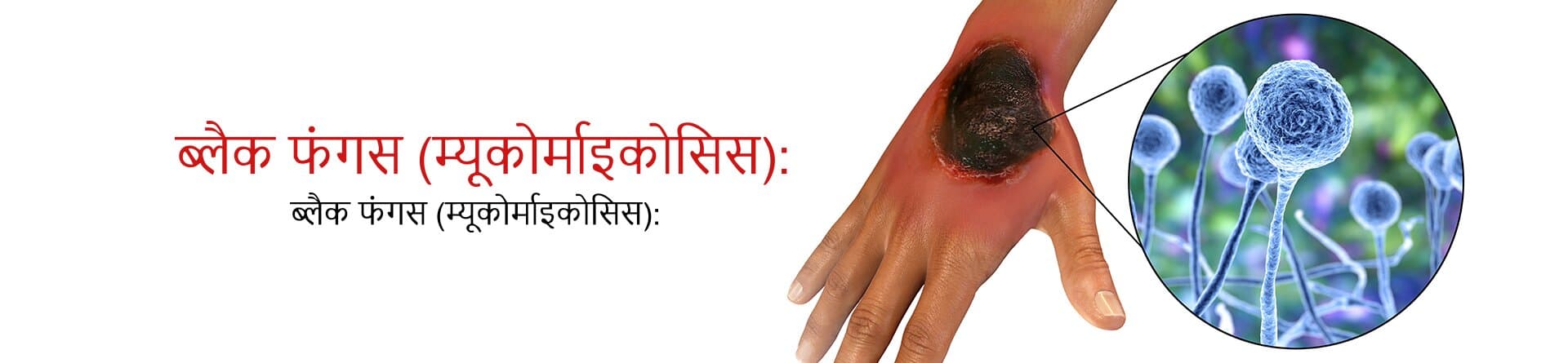 ब्लैक फंगस (म्यूकोर्माइकोसिस): जानें इसके लक्षण और सही इलाज