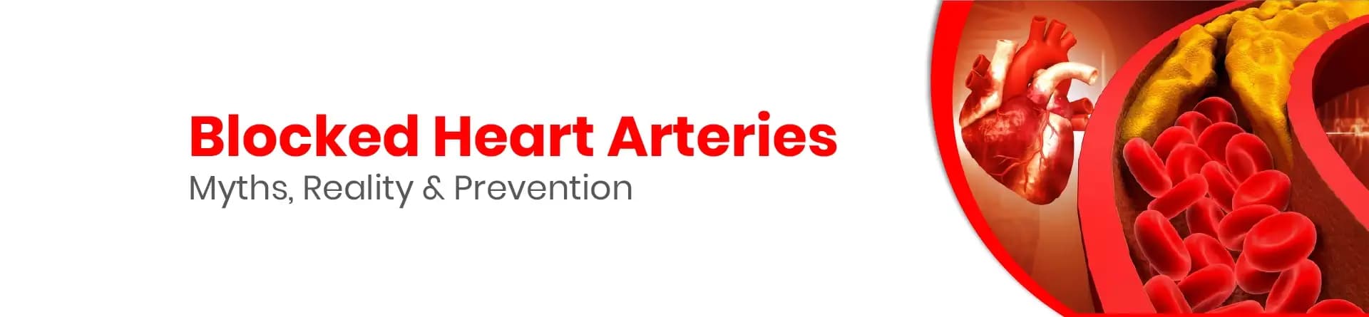 Blocked Heart Arteries: Myths, Reality & Prevention