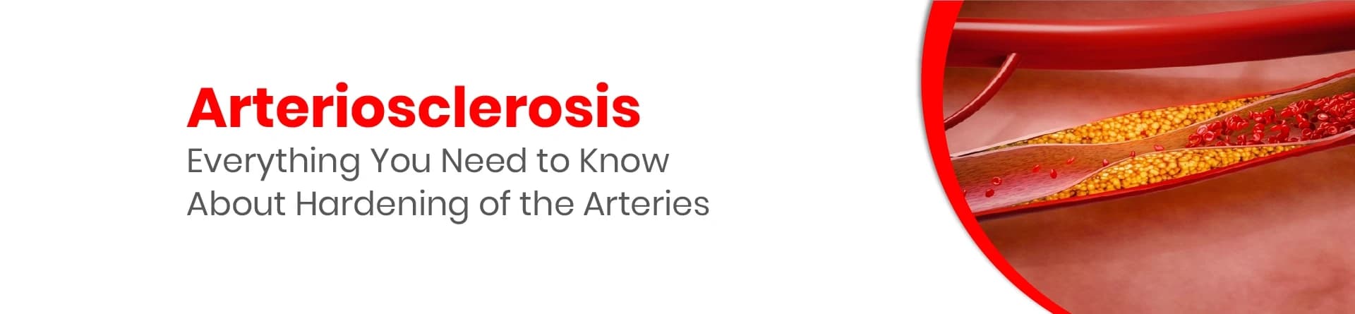 Arteriosclerosis: Causes, Symptoms, Diagnosis & Treatment