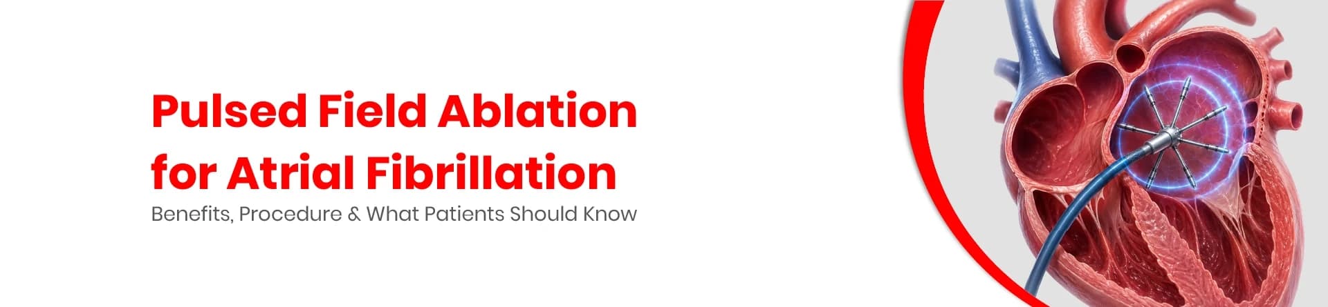 Pulsed Field Ablation for Atrial Fibrillation: Benefits and Procedure