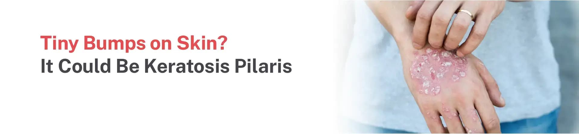 Tiny Bumps on Skin? It Could Be Keratosis Pilaris