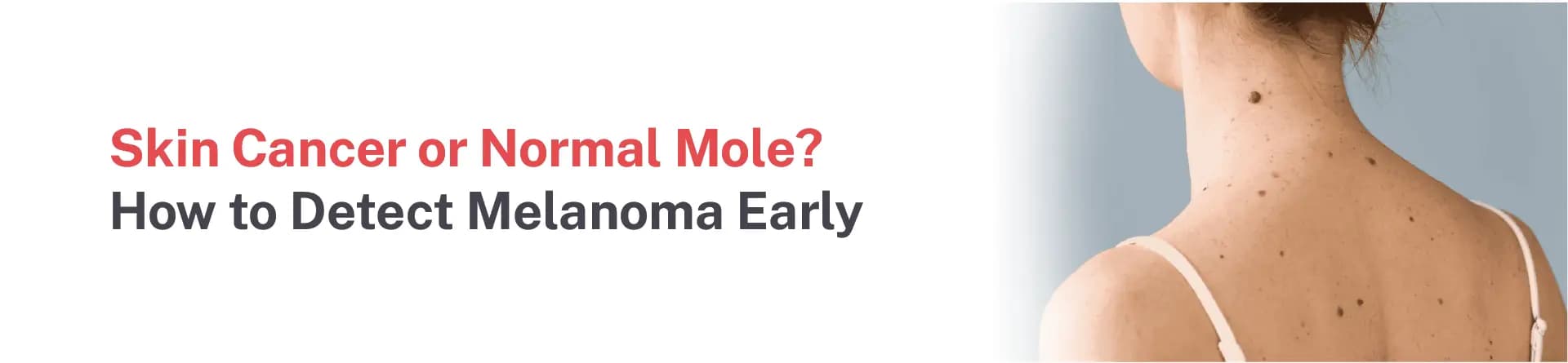 Skin Cancer or Normal Mole? How to Detect Melanoma Early