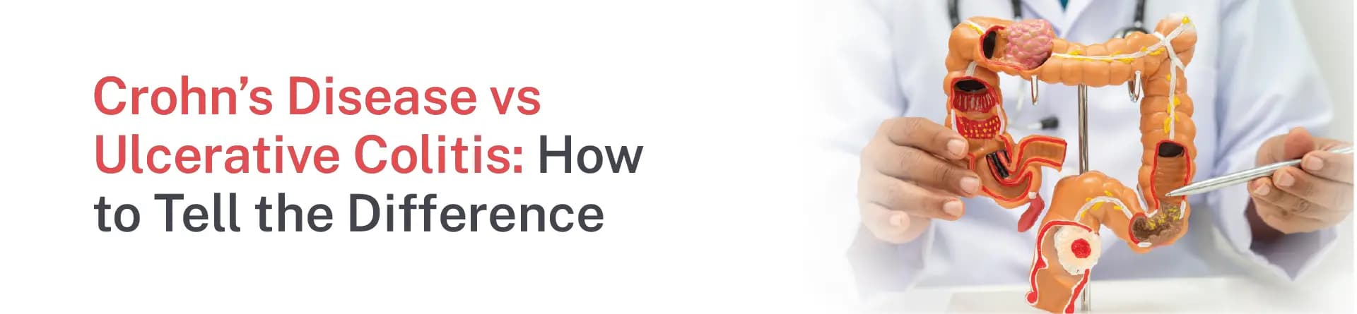 Crohn’s Disease vs Ulcerative Colitis: How to Tell the Difference