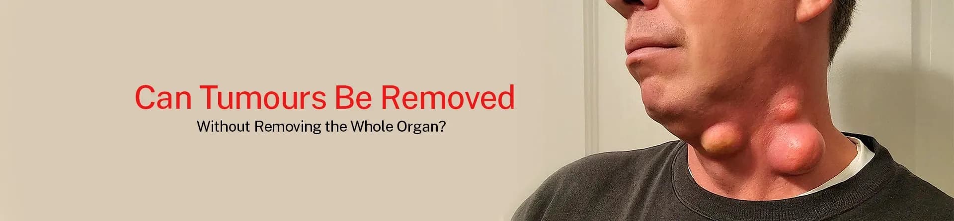 Can Tumours Be Removed Without Removing the Whole Organ?