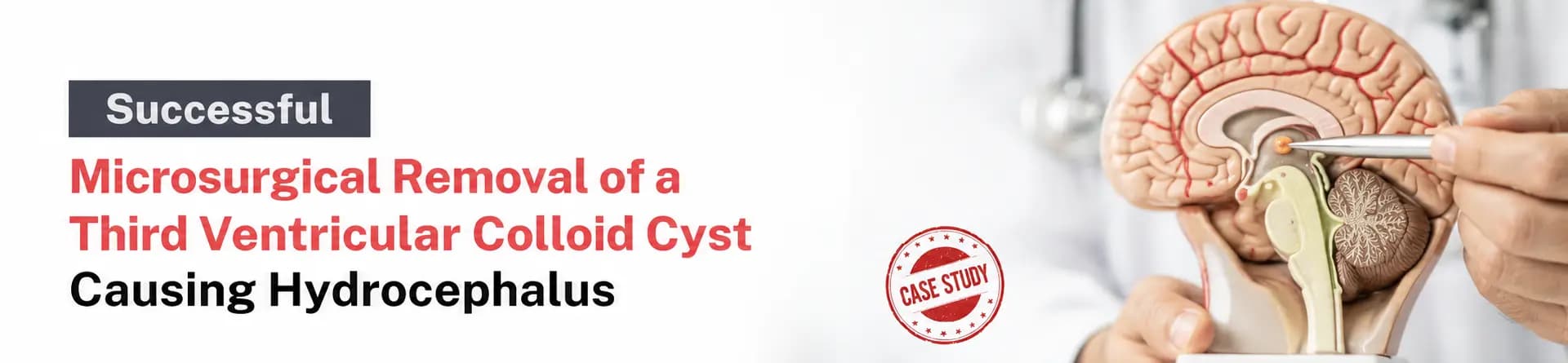 Successful Microsurgical Removal of a Third Ventricular Colloid Cyst Causing Hydrocephalus