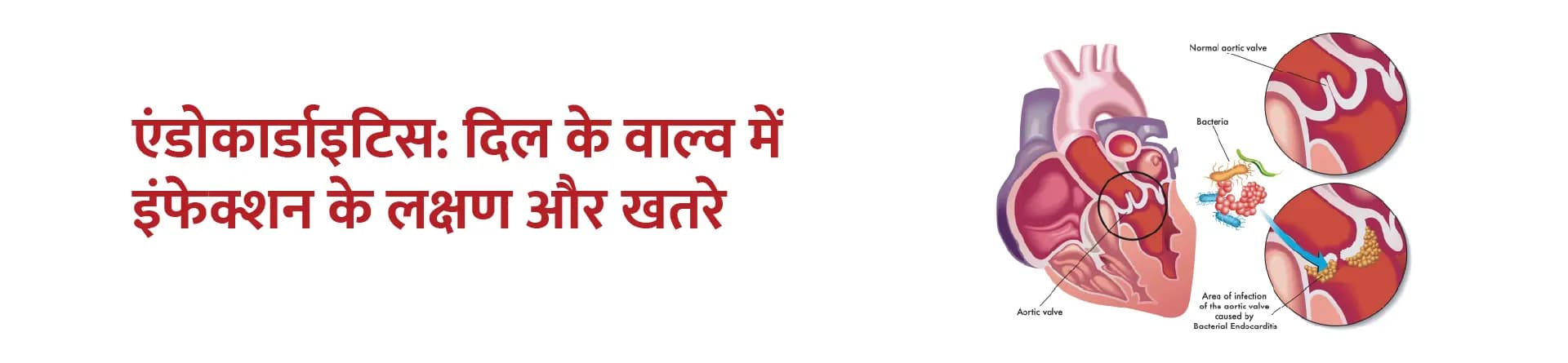 एंडोकार्डाइटिस: दिल के वाल्व में इंफेक्शन के लक्षण और खतरे