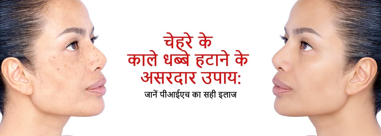 चेहरे के काले धब्बे हटाने के असरदार उपाय: जानें पीआईएच का सही इलाज