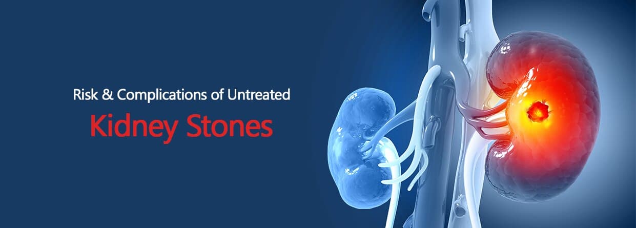 Risk & Complications of Untreated Kidney Stones