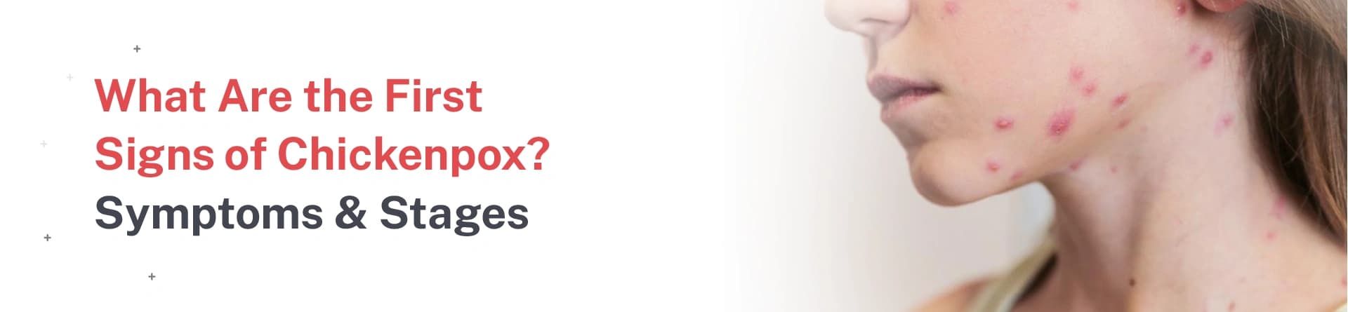 First Signs Of Chickenpox Early Symptoms Stages Explained First Signs Of Chickenpox Early Symptoms Stages Explained