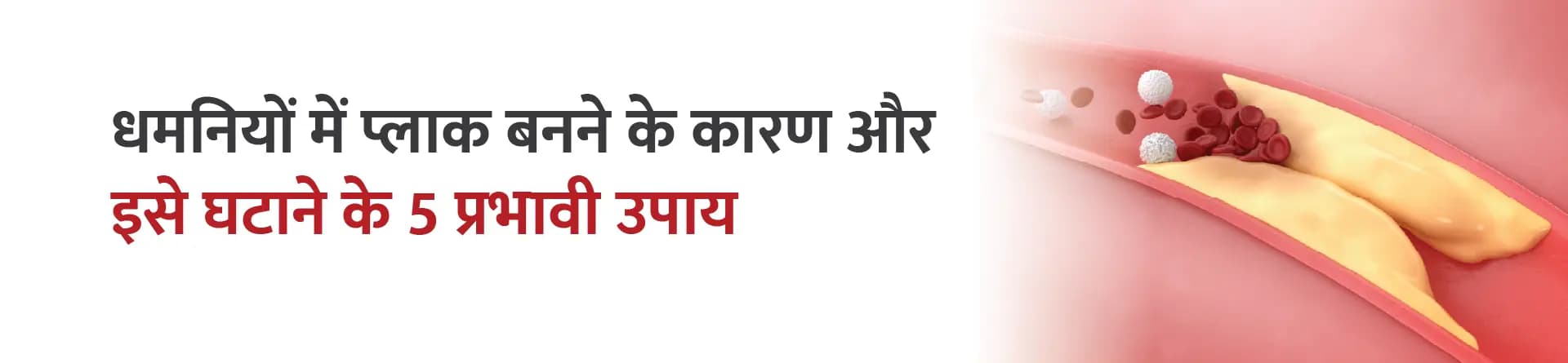 धमनियों में प्लाक बनने के कारण और इसे घटाने के 5 प्रभावी उपाय