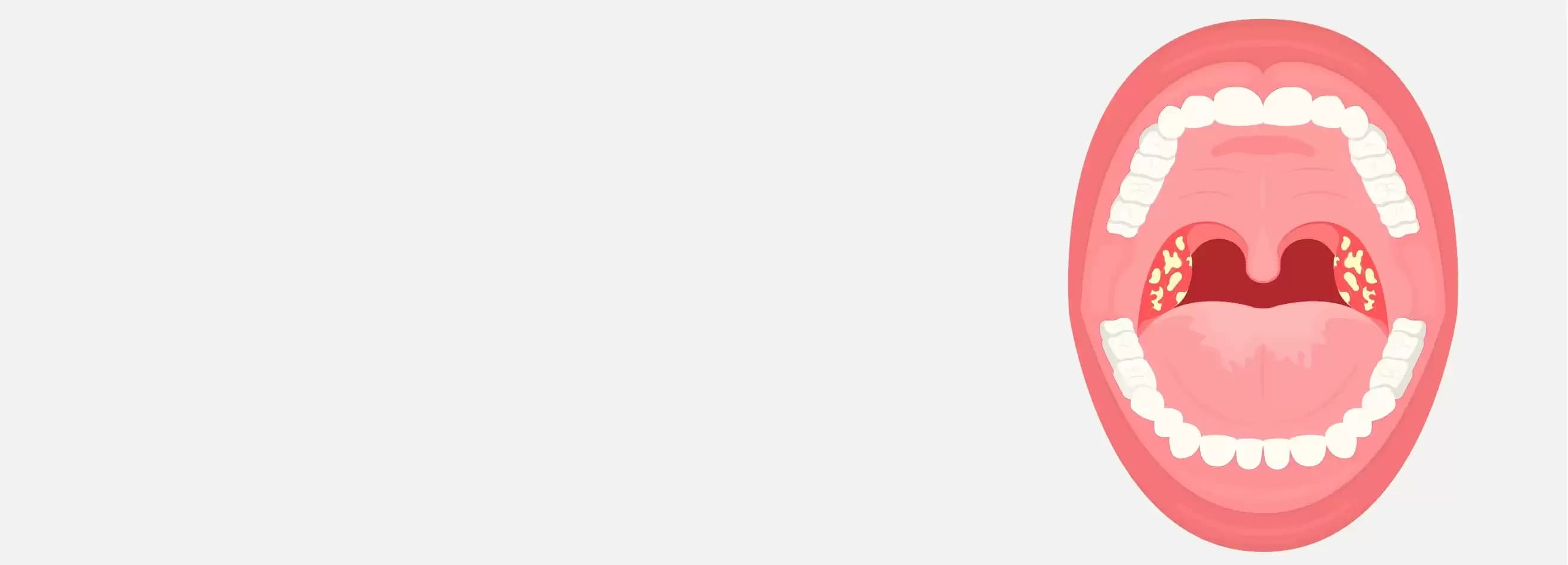 Tonsil Removal (Tonsillectomy) Surgery