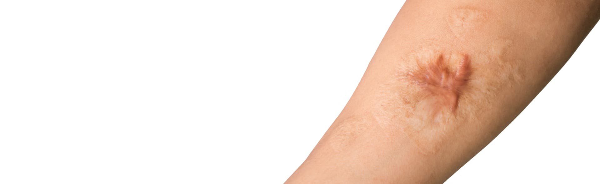Burn Scar Treatment