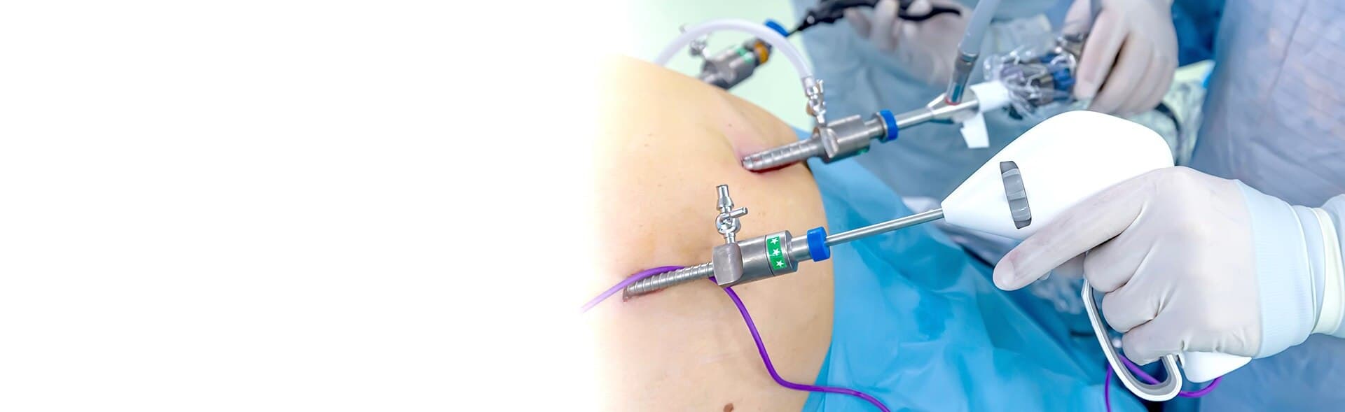 Gastric Bypass Surgery