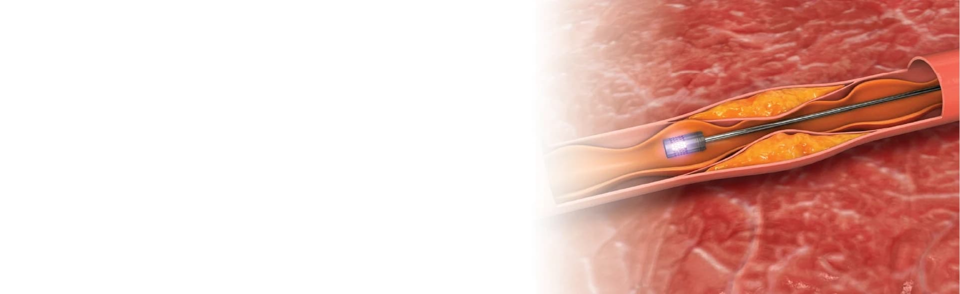 Catheter Ablation