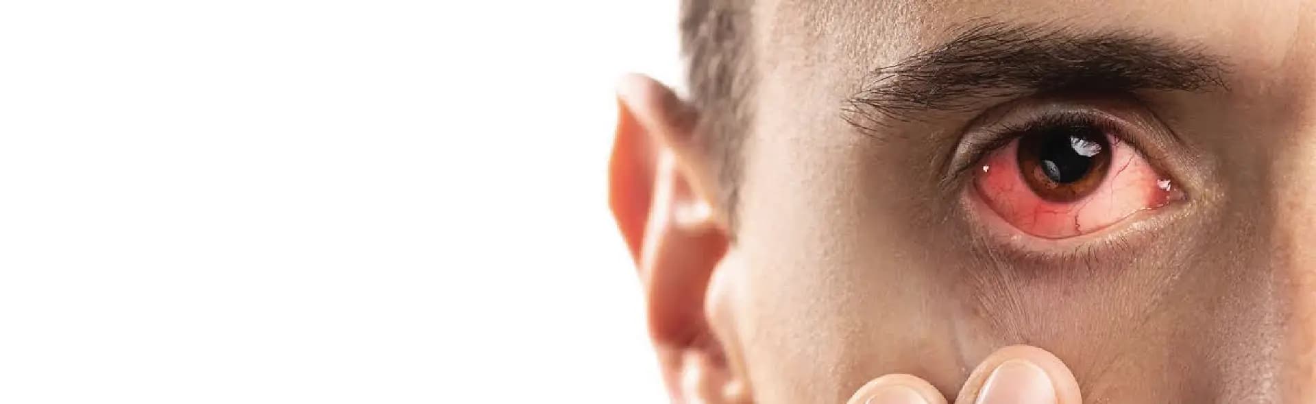 Conjunctivitis (Pink Eye) Treatment