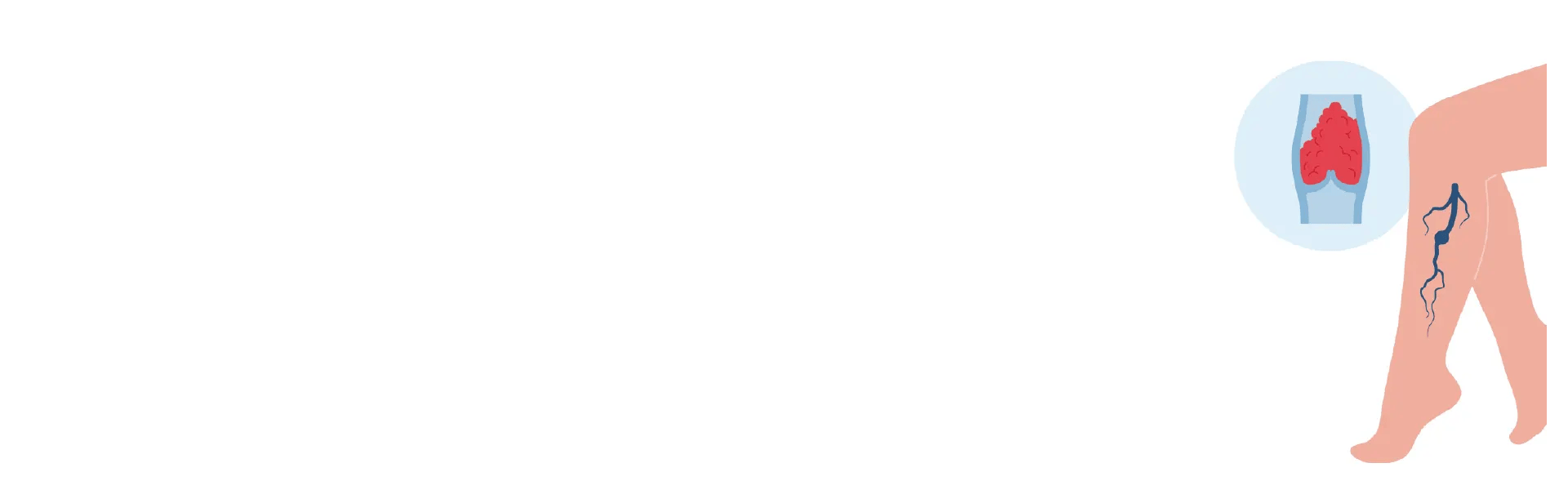 Thrombectomy Treatment