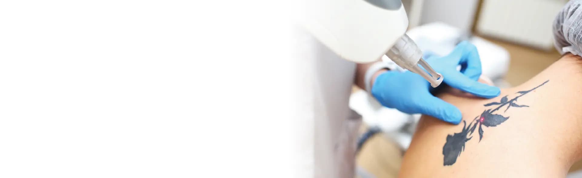Tattoo Removal
