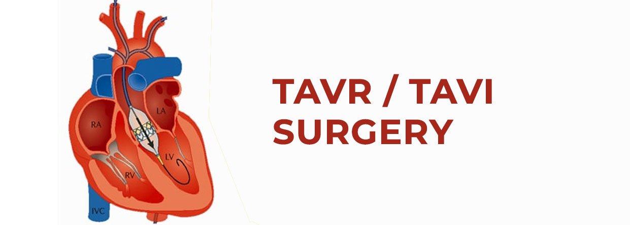Transcatheter Aortic Valve Replacement (TAVI/TAVR)