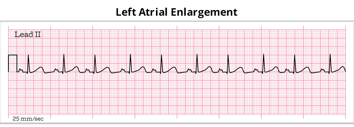 What You Must Know About Left Atrial enlargement?