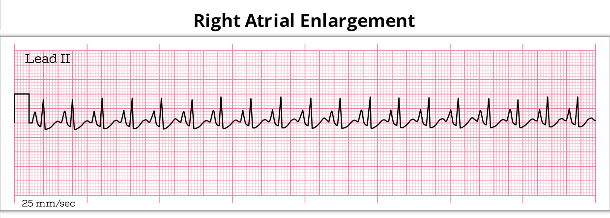 Right Atrial Enlargement: Everything You Need to Know