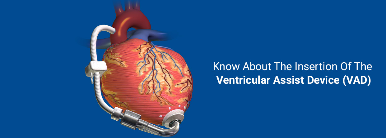 Know About The Insertion Of The Ventricular Assist Device (VAD)