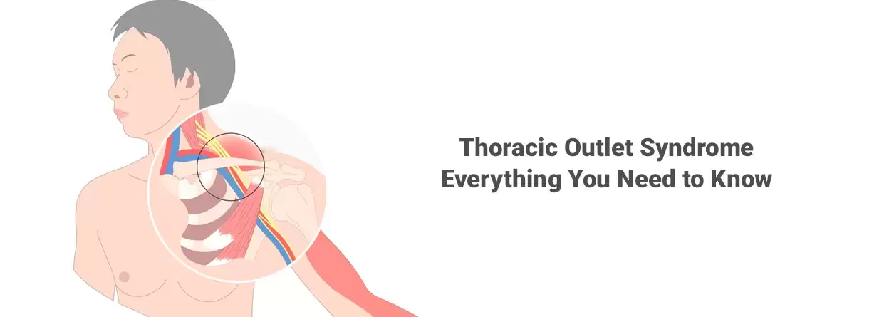 Thoracic Outlet Syndrome - Everything You should  Know