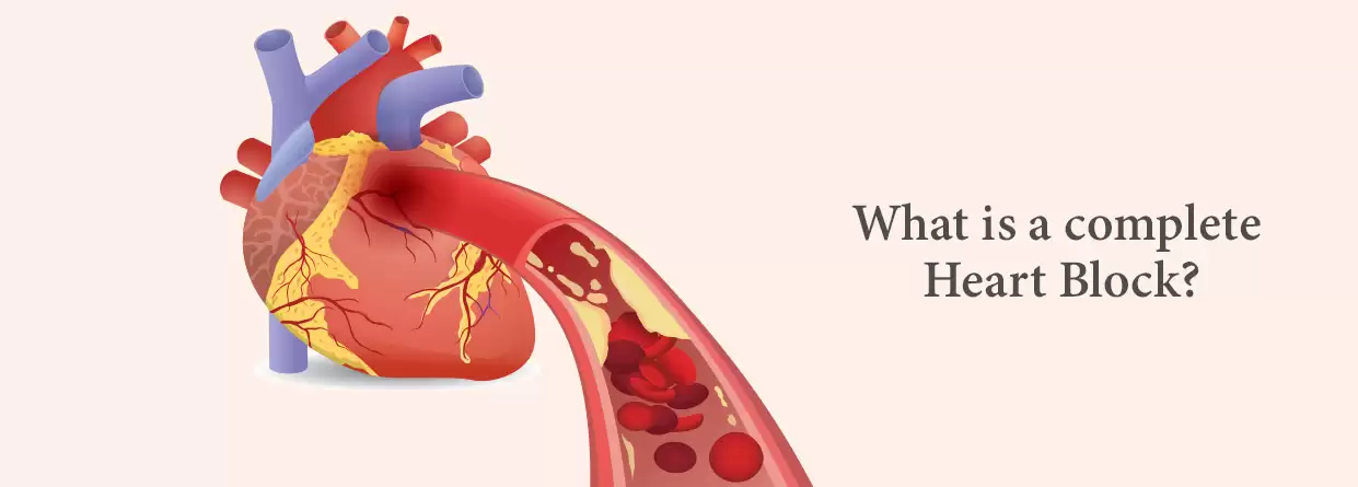What is a Complete Heart Block?