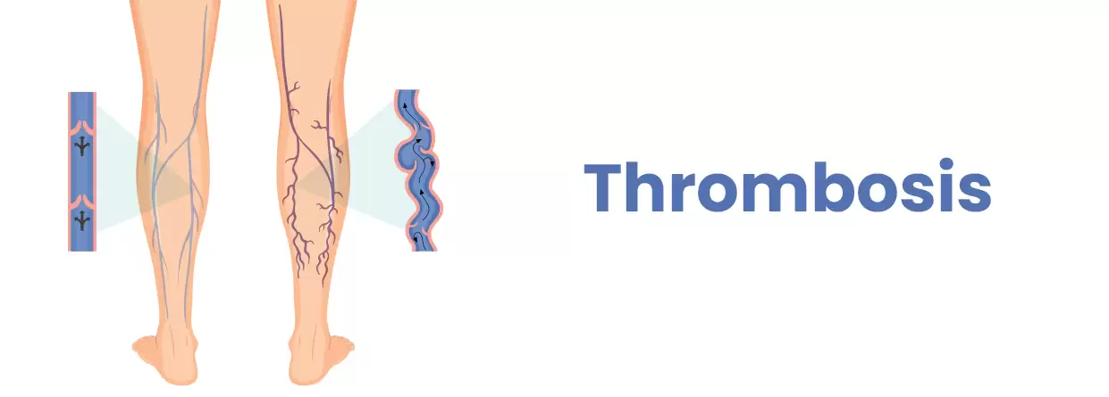 Thrombosis- Your Ultimate Guide