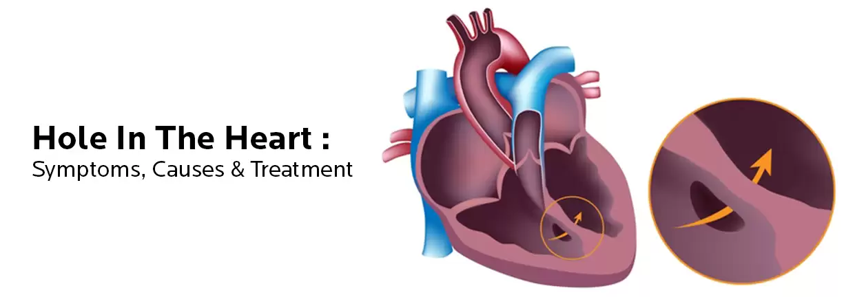 Understanding the Impact of A Hole In The Heart - Symptoms, Causes & Treatment