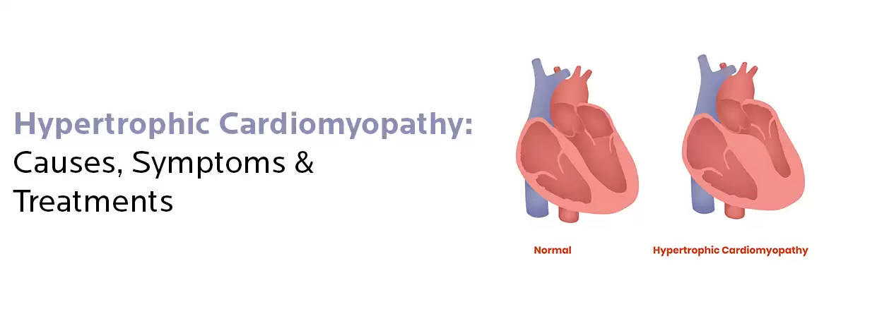 Hypertrophic Cardiomyopathy- Understanding Causes, Symptoms & Treatment