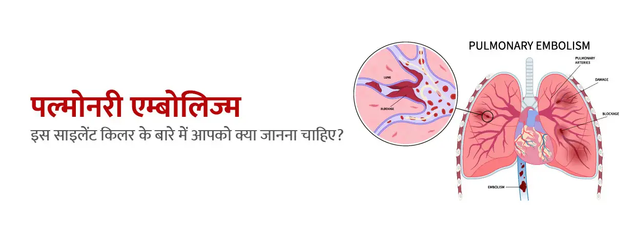 पल्मोनरी एम्बोलिज्म: इस साइलेंट किलर के बारे में आपको क्या जानना चाहिए