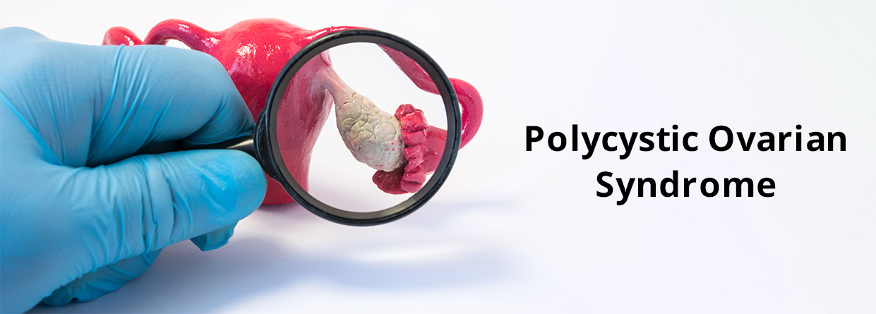 PCOS (Polycystic Ovary Syndrome): What You Should Know