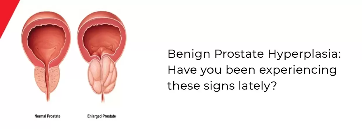 Benign Prostate Hyperplasia: Have you been experiencing these signs lately?