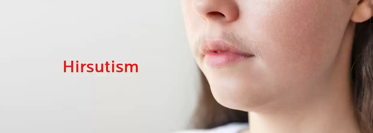 Hirsutism: All You Need to Know