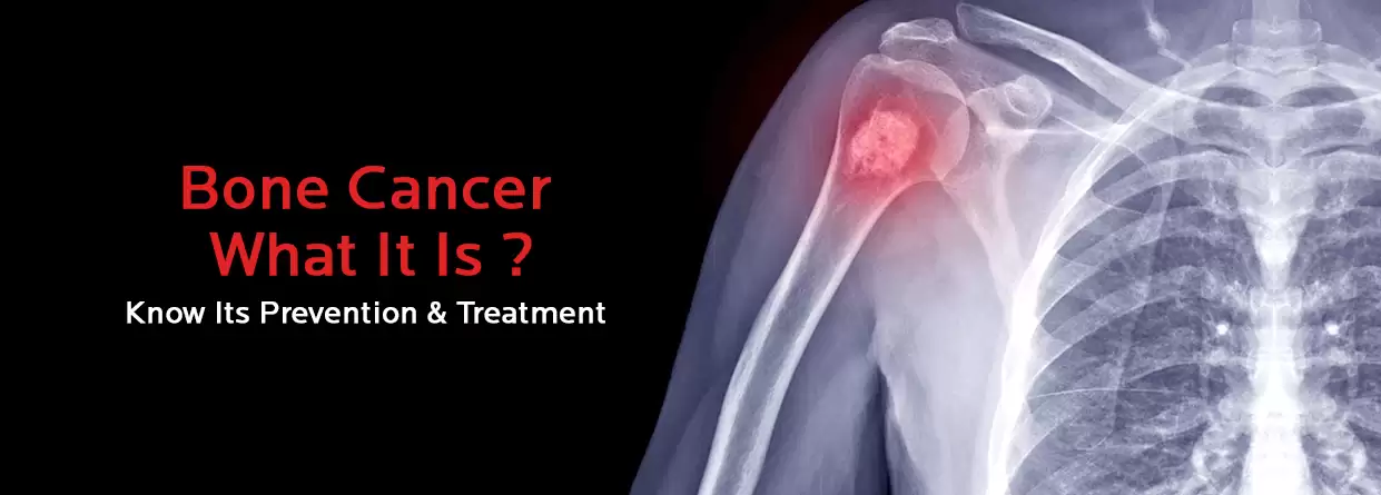 Bone Cancer- All You Need to Know