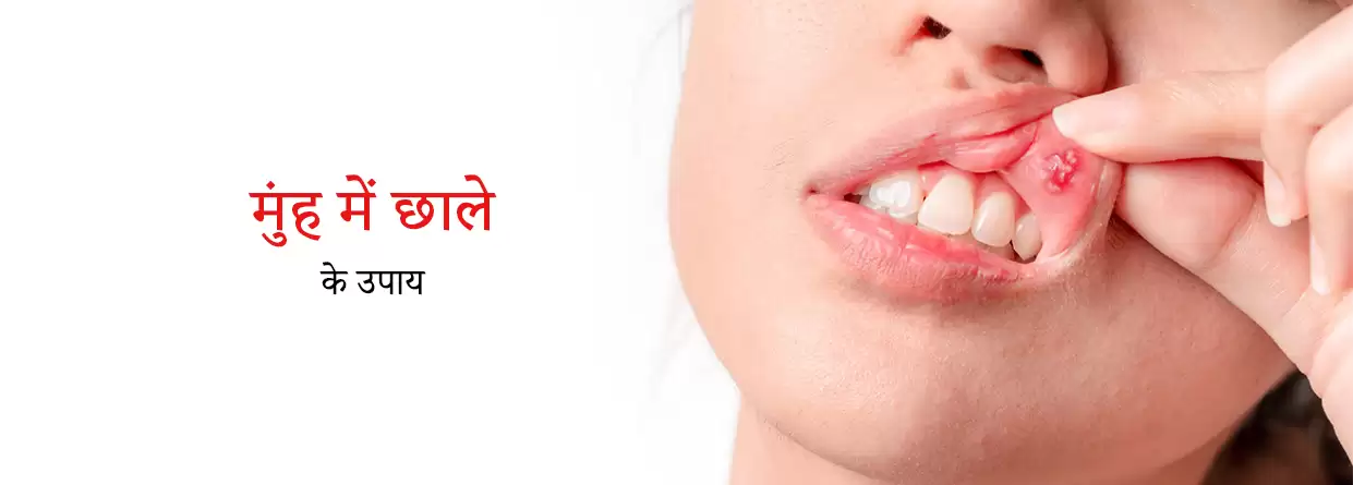 मुंह में छाले के उपाय | Home Remedies for Mouth Ulcers in Hindi