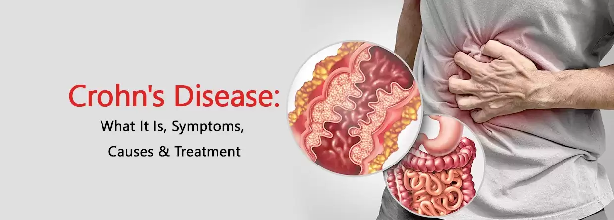 Crohn's Disease Unveiled: Symptoms, Causes