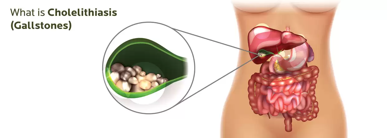 Your Ultimate Guide for Gallstones (Cholelithiasis)